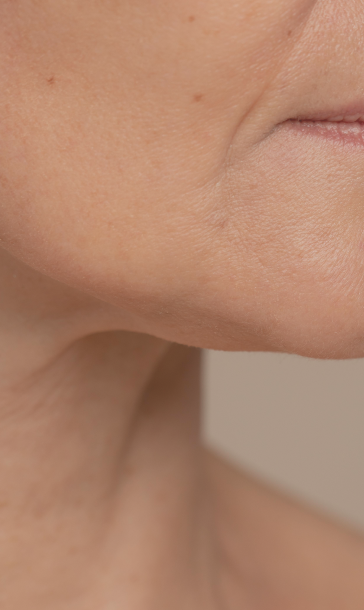 InMode: BodyTite, FaceTite e AccuTite - Pontello Cosmiatria Laser