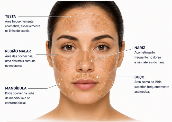 Ilustração do mapa facial do melasma mostrando os padrões clínicos centrofacial, malar e mandibular