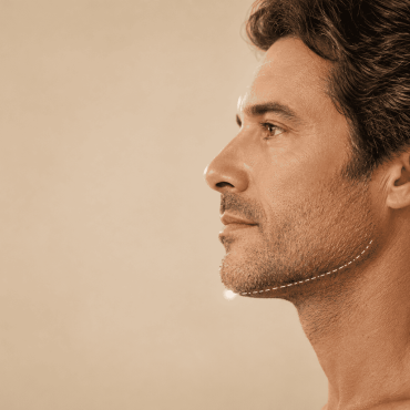 Homem em perfil lateral ilustrando o preenchimento de mento e a melhora da projeção do queixo e do perfil facial.