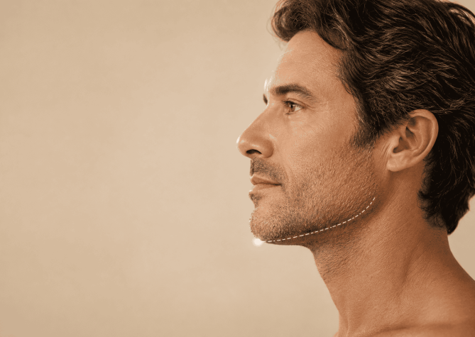 Homem em perfil lateral ilustrando o preenchimento de mento e a melhora da projeção do queixo e do perfil facial.